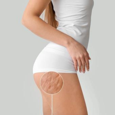 V-30: Non-Invasive Treatment for Cellulite Reduction and Body Contouring