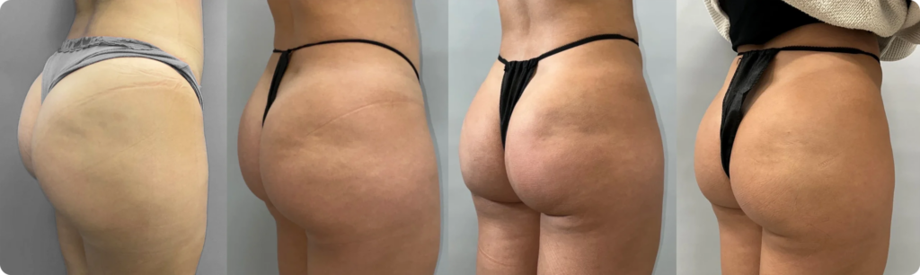 Enhance Shape & Volume Without Surgery