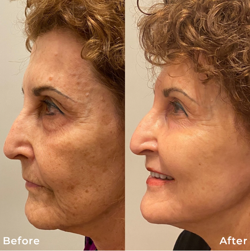 CO2-Fractional-Laser-Skin-Resurfacing-Treatment-Carbon-Dioxide-Before-After-Photo-Pic-Los-Angeles-Pasadena-CA-Skin-Rejuvenation-1