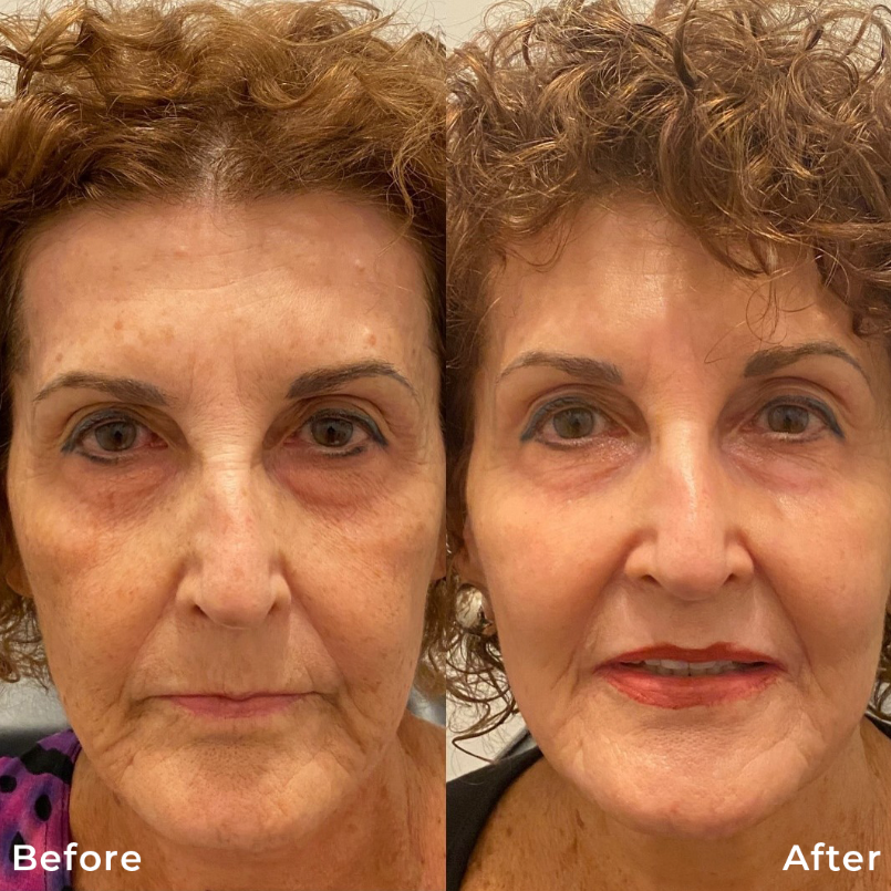 CO2-Fractional-Laser-Skin-Resurfacing-Treatment-Carbon-Dioxide-Before-After-Photo-Pic-Los-Angeles-Pasadena-CA-Skin-Rejuvenation-1a