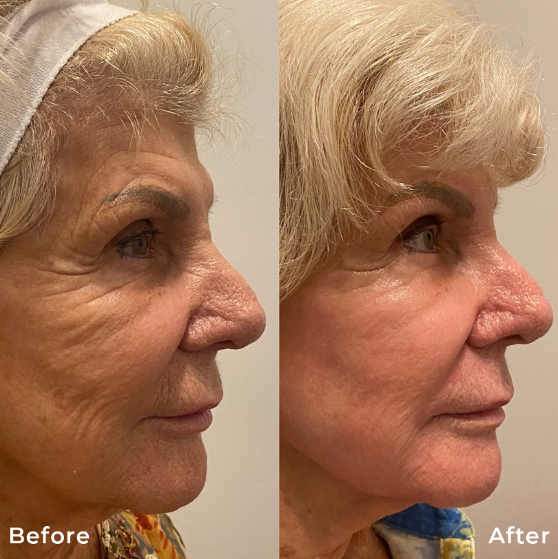 CO2-Fractional-Laser-Skin-Resurfacing-Treatment-Carbon-Dioxide-Before-After-Photo-Pic-Los-Angeles-Pasadena-CA-Skin-Rejuvenation-5