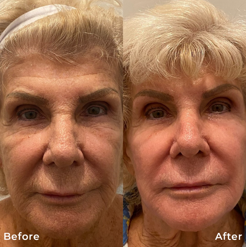 CO2-Fractional-Laser-Skin-Resurfacing-Treatment-Carbon-Dioxide-Before-After-Photo-Pic-Los-Angeles-Pasadena-CA-Skin-Rejuvenation-6