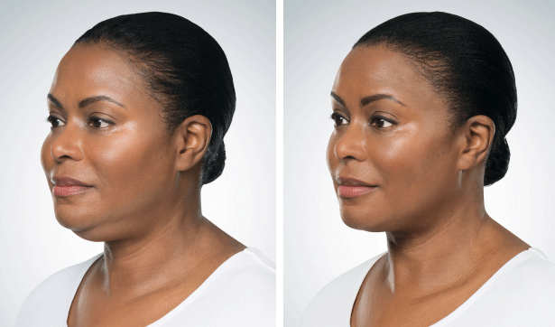Kybella Miami