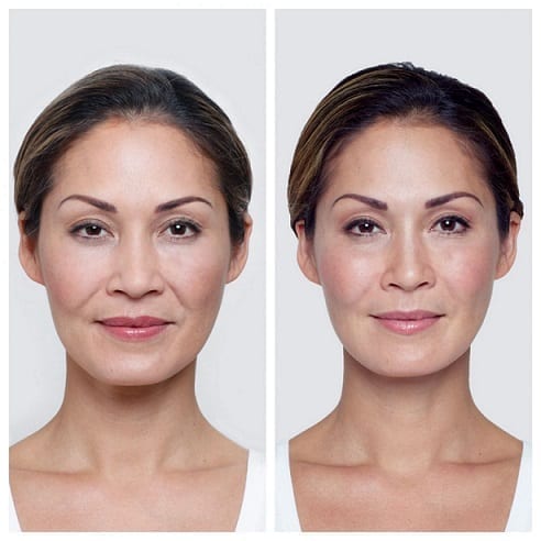 Restylane Miami