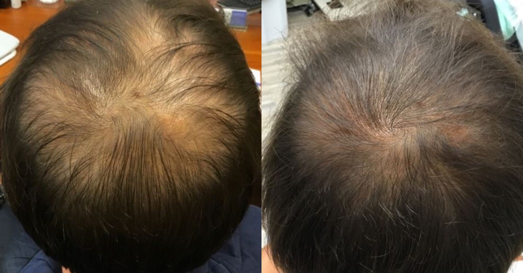 PRP Therapy Hair Restoration Miami