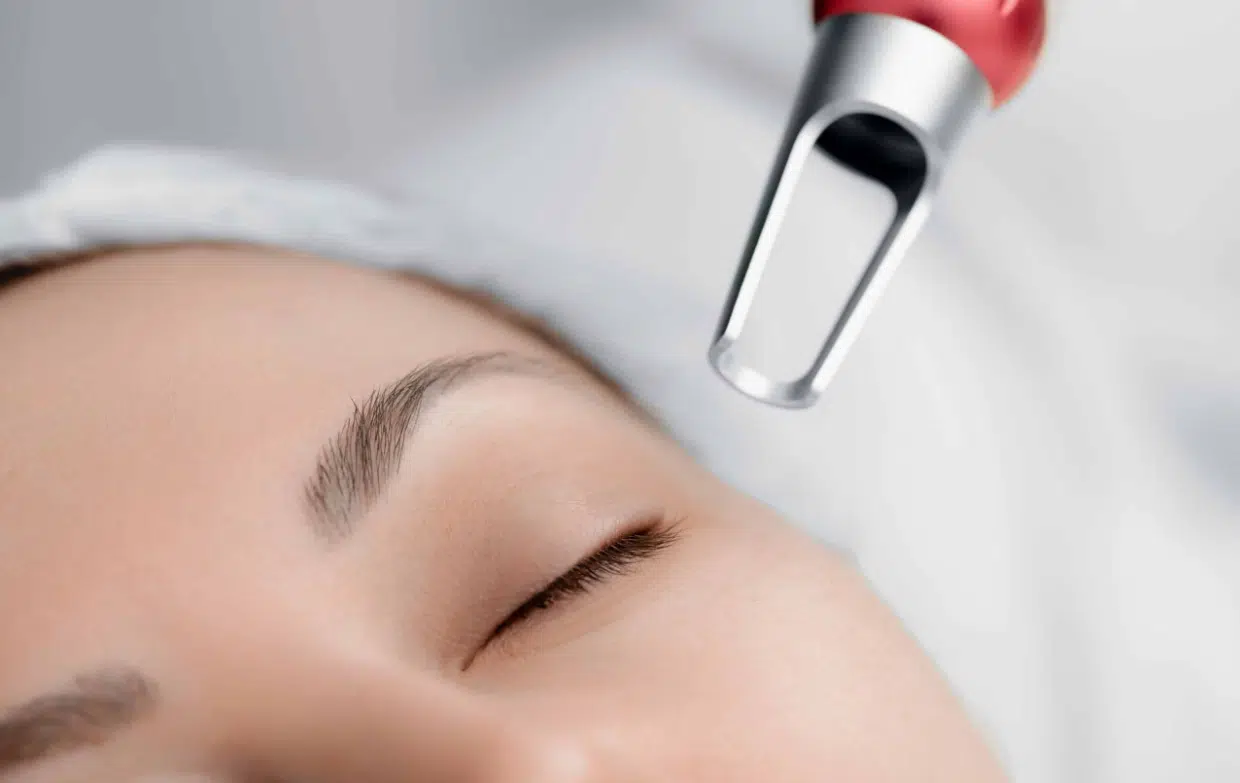Picolaser Scar Treatment Miami