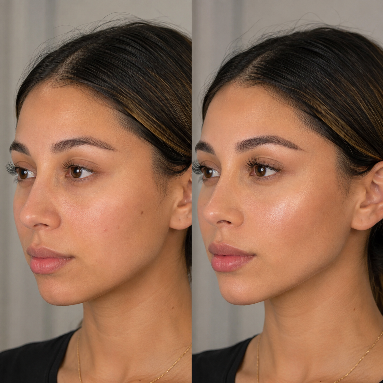 Facial Harmonization Miami | Natural Facial Balancing & Enhancement
